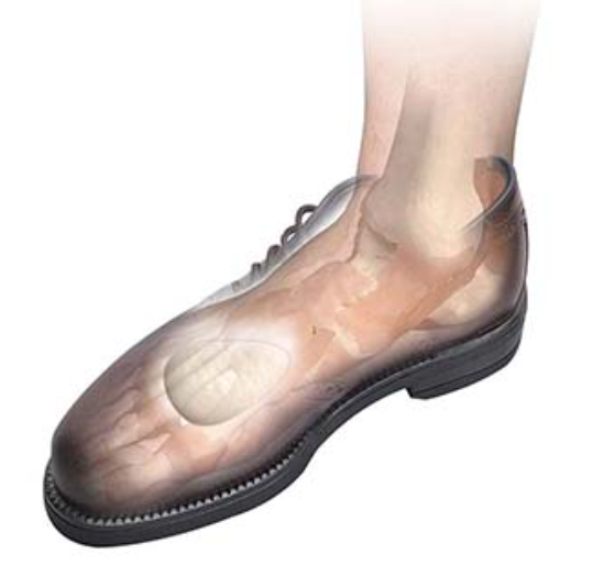 Metatarsal Pads